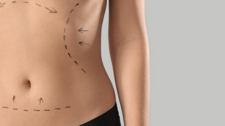 Top-Rated Liposuction Clinic Near Lexington Park MD